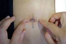 acupuncture ilustration